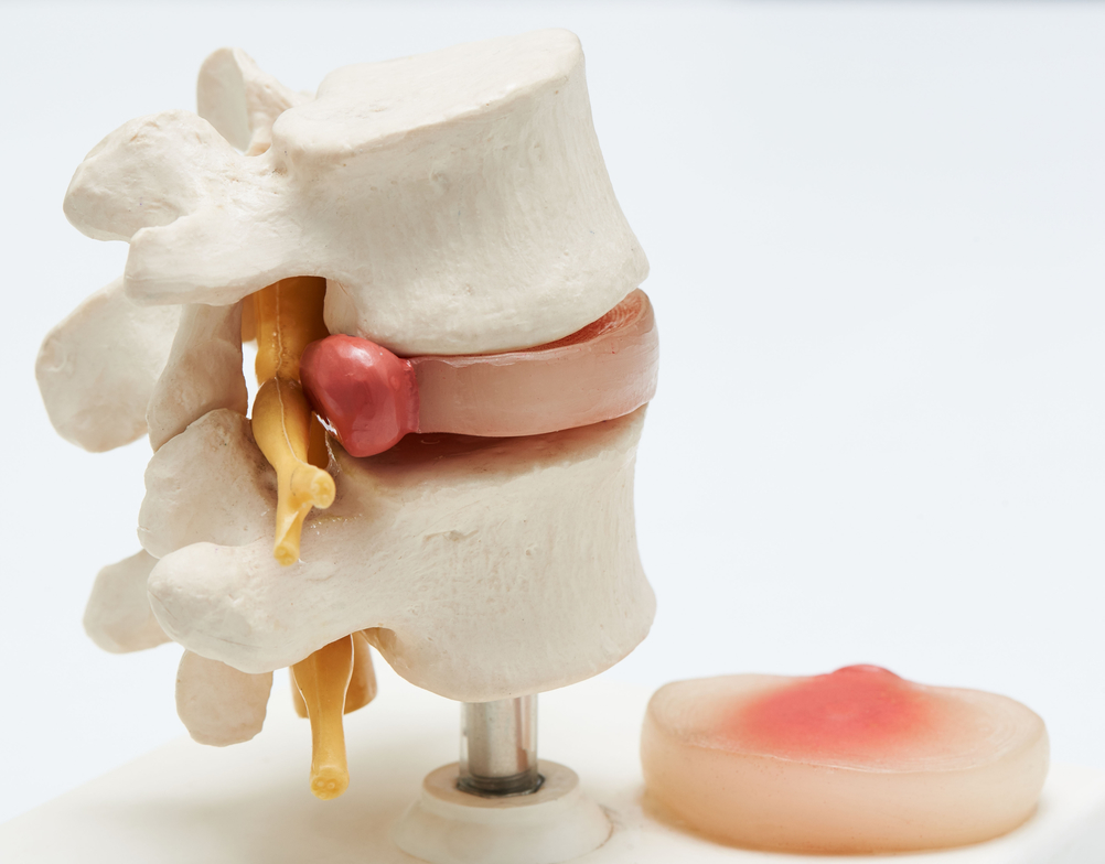 Anatomy model displaying red herniated lumbar disc