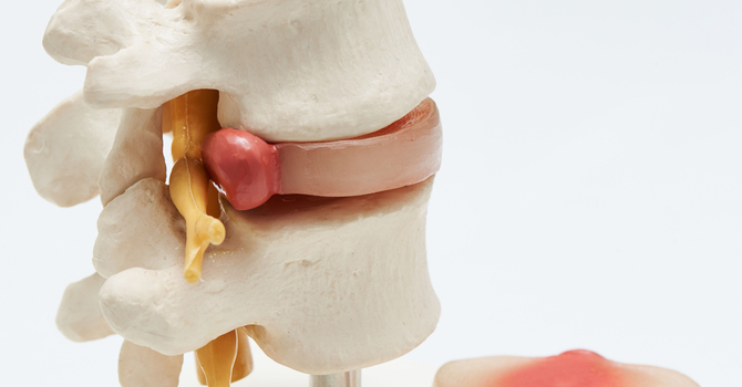 Have You Been Told You Have A “Pinched Nerve” Or “Sciatica”? image