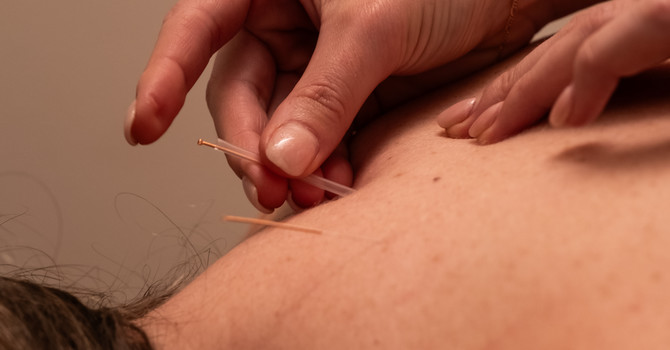 The Benefits of Acupuncture in West Kelowna: A Natural Path to Wellness