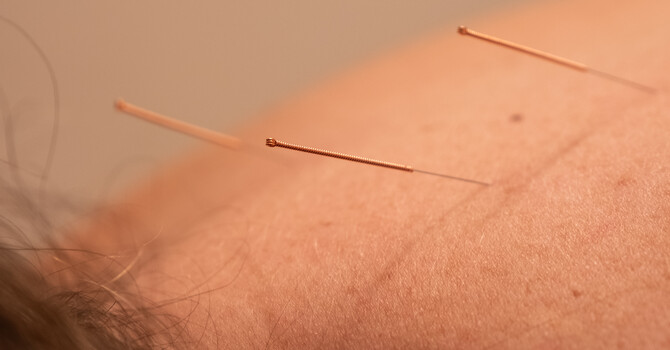 Acupuncture vs Dry Needling: Understanding the Differences image