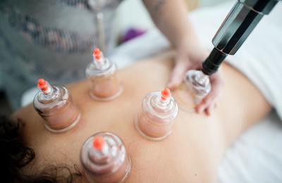 Chiropractic cupping therapy on massage table